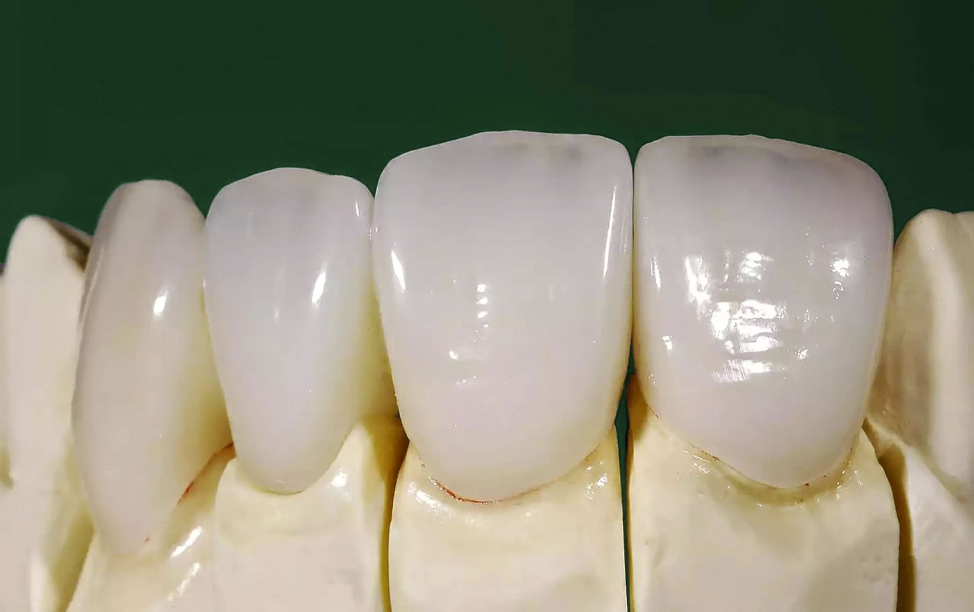 Corona dental cerámica