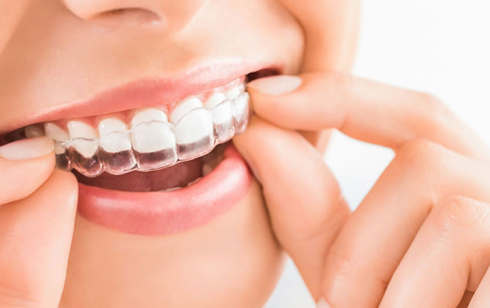 Invisalign en Palencia