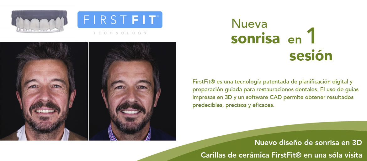 FirstFit carillas dentales